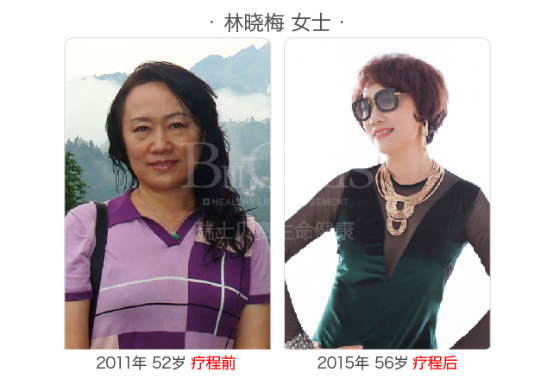 瑞士贝赛抗衰老案例林晓梅女士