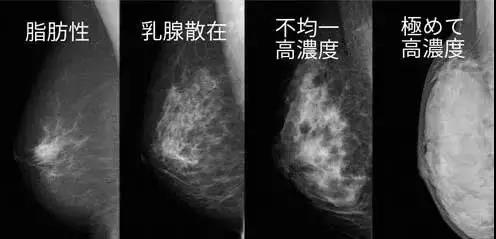 乳腺 X 线钼靶影像学下的乳腺密度分为不同等级，到了最高浓度的最右这张画面上基本已经什么都看不出来.